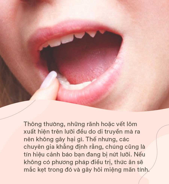 Lưỡi không chỉ giúp bạn nói mà ngay cả các loại bệnh nguy hiểm nó cũng 'lên tiếng' được thông qua 5 dấu hiệu - 2 Lưỡi không chỉ giúp bạn nói mà ngay cả các loại bệnh nguy hiểm nó cũng 'lên tiếng' được thông qua 5 dấu hiệu - 2
