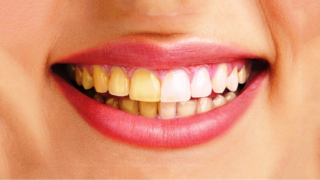 Vì sao răng bị ố vàng? Vì sao răng bị ố vàng?