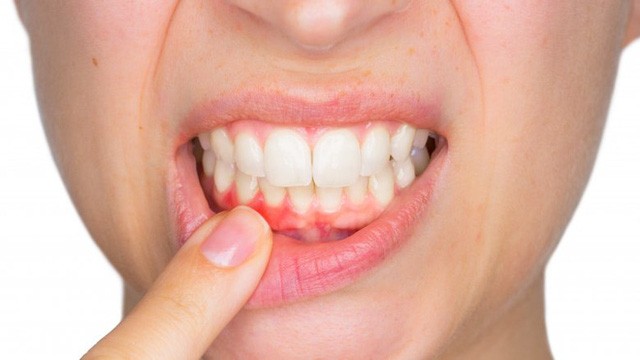 Những căn bệnh từ việc không đánh răng hàng ngày - 4 Những căn bệnh từ việc không đánh răng hàng ngày - 4