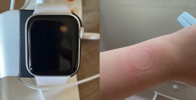 Apple Watch SE gặp lỗi quá nhiệt, khiến người dùng bị bỏng và làm hỏng màn hình Apple Watch SE gặp lỗi quá nhiệt, khiến người dùng bị bỏng và làm hỏng màn hình