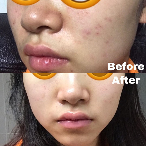 Biết 6 chiêu nặn mụn đúng cách, da sẽ nhanh lành, vết thâm cũng không có cửa xuất hiện Biết 6 chiêu nặn mụn đúng cách, da sẽ nhanh lành, vết thâm cũng không có cửa xuất hiện