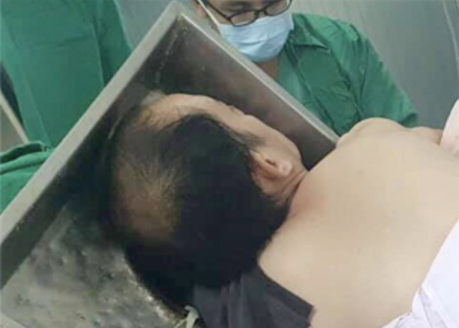 Tai nạn kinh hoàng: Chàng trai 27 tuổi bị máy xay thịt cuốn cả cánh tay đến sát vai, mặt bị kéo vào mâm inox, tình trạng nguy kịch - 2 Tai nạn kinh hoàng: Chàng trai 27 tuổi bị máy xay thịt cuốn cả cánh tay đến sát vai, mặt bị kéo vào mâm inox, tình trạng nguy kịch - 2