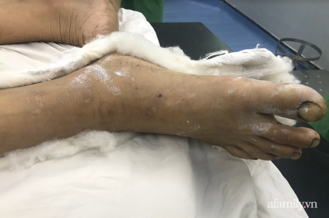 Tai nạn kinh hoàng: Người đàn ông bị máy cưa cắt thẳng vào đùi và cẳng chân mất máu nặng, tình trạng nguy kịch Tai nạn kinh hoàng: Người đàn ông bị máy cưa cắt thẳng vào đùi và cẳng chân mất máu nặng, tình trạng nguy kịch
