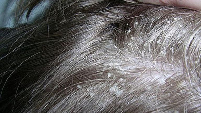 Bác sĩ da liễu cảnh báo bệnh về da dễ bị chẩn đoán nhầm, gây khó khăn trong điều trị - 5 Bác sĩ da liễu cảnh báo bệnh về da dễ bị chẩn đoán nhầm, gây khó khăn trong điều trị - 5