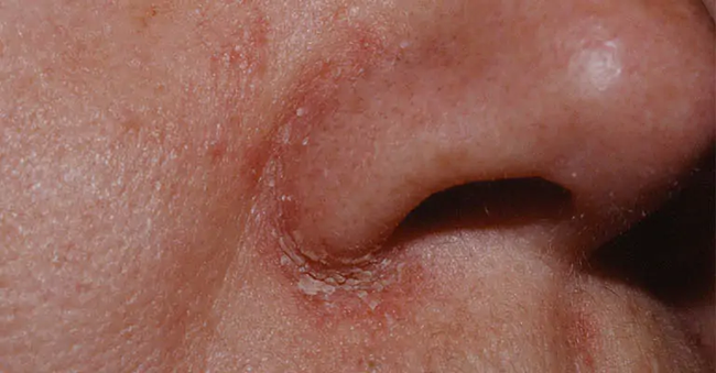Bác sĩ da liễu cảnh báo bệnh về da dễ bị chẩn đoán nhầm, gây khó khăn trong điều trị Bác sĩ da liễu cảnh báo bệnh về da dễ bị chẩn đoán nhầm, gây khó khăn trong điều trị