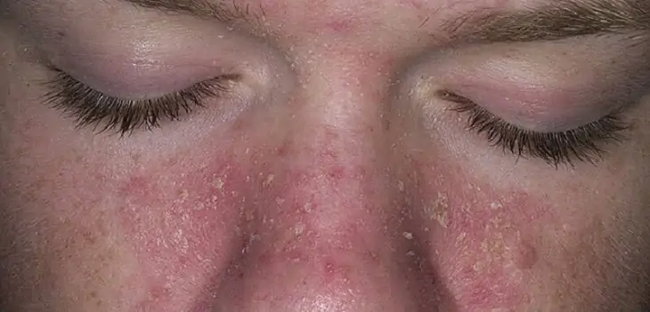 Bác sĩ da liễu cảnh báo bệnh về da dễ bị chẩn đoán nhầm, gây khó khăn trong điều trị - 1 Bác sĩ da liễu cảnh báo bệnh về da dễ bị chẩn đoán nhầm, gây khó khăn trong điều trị - 1