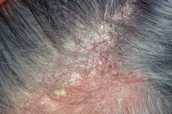 Bác sĩ da liễu cảnh báo bệnh về da dễ bị chẩn đoán nhầm, gây khó khăn trong điều trị - 3 Bác sĩ da liễu cảnh báo bệnh về da dễ bị chẩn đoán nhầm, gây khó khăn trong điều trị - 3