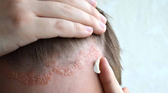 Bác sĩ da liễu cảnh báo bệnh về da dễ bị chẩn đoán nhầm, gây khó khăn trong điều trị - 4 Bác sĩ da liễu cảnh báo bệnh về da dễ bị chẩn đoán nhầm, gây khó khăn trong điều trị - 4