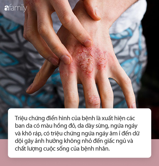 Chuyên gia da liễu tiết lộ 3 bệnh về da thường gặp vào mùa đông, muốn phòng tránh phải làm đủ 10 điều quan trọng - 1 Chuyên gia da liễu tiết lộ 3 bệnh về da thường gặp vào mùa đông, muốn phòng tránh phải làm đủ 10 điều quan trọng - 1