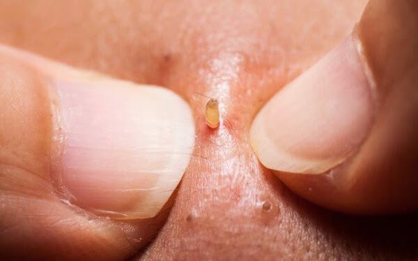 Người đàn ông viêm phổi nặng, suýt tử vong vì nặn mụn ở vị trí 'cấm': BS cảnh báo khu vực 'tử thần', cấm nặn mụn kẻo rước họa - 2 Người đàn ông viêm phổi nặng, suýt tử vong vì nặn mụn ở vị trí 'cấm': BS cảnh báo khu vực 'tử thần', cấm nặn mụn kẻo rước họa - 2