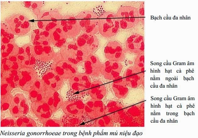 Nhiều nam giới mắc bệnh lậu, bác sĩ chỉ rõ thủ phạm - 1 Nhiều nam giới mắc bệnh lậu, bác sĩ chỉ rõ thủ phạm - 1
