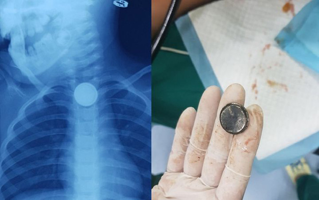 Thực quản của đứa trẻ 2 tuổi bị cháy đen, phải mổ cấp cứu vì ăn phải thứ này Thực quản của đứa trẻ 2 tuổi bị cháy đen, phải mổ cấp cứu vì ăn phải thứ này