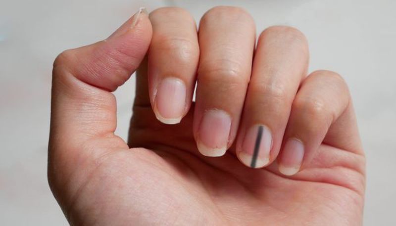 Người đàn ông đột ngột phát hiện ung thư phổi, BS nhắc nhở: 4 dấu hiệu này trên tay nghĩa là ung thư đã đến giai đoạn giữa và cuối - 3 Người đàn ông đột ngột phát hiện ung thư phổi, BS nhắc nhở: 4 dấu hiệu này trên tay nghĩa là ung thư đã đến giai đoạn giữa và cuối - 3
