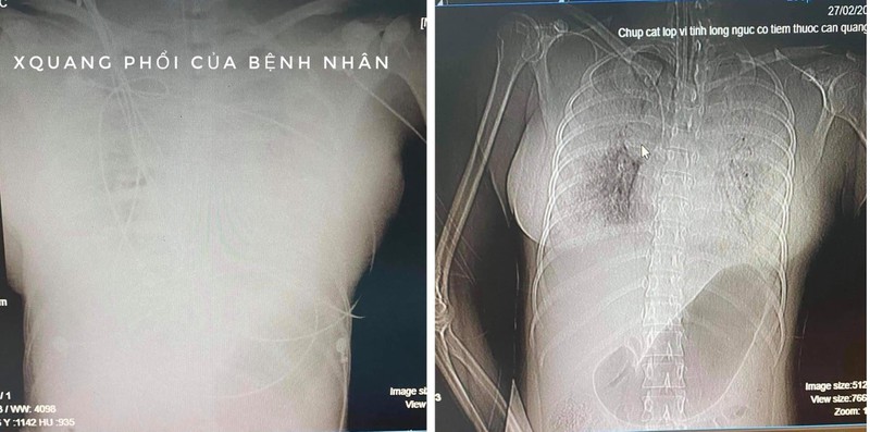TP.HCM: Người phụ nữ 32 tuổi tử vong bất thường sau 1 tuần tiêm filler nâng ngực TP.HCM: Người phụ nữ 32 tuổi tử vong bất thường sau 1 tuần tiêm filler nâng ngực