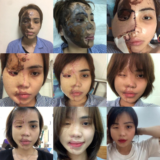 Cô gái bị chồng sắp cưới tạt axit xuất hiện với tạo hình mới lạ trong bộ ảnh đậm chất nghệ thuật Cô gái bị chồng sắp cưới tạt axit xuất hiện với tạo hình mới lạ trong bộ ảnh đậm chất nghệ thuật