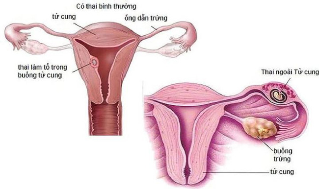 Nữ sinh 21 tuổi đau bụng dữ dội tưởng bị cảm lạnh, nào ngờ suýt mất mạng vì chửa ngoài tử cung mà không biết - 1 Nữ sinh 21 tuổi đau bụng dữ dội tưởng bị cảm lạnh, nào ngờ suýt mất mạng vì chửa ngoài tử cung mà không biết - 1