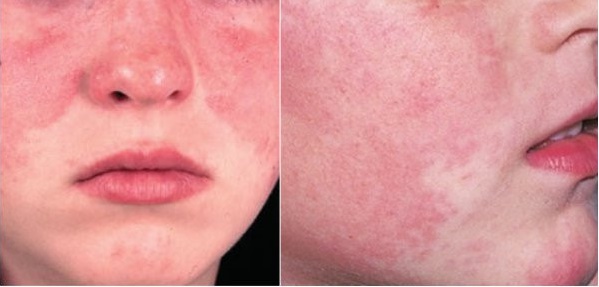 Bệnh nhân Lupus ban đỏ có nên tiêm vaccine ngừa COVID-19 không? - 1 Bệnh nhân Lupus ban đỏ có nên tiêm vaccine ngừa COVID-19 không? - 1