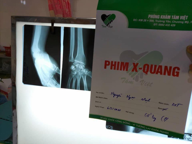 'Người hùng' Nguyễn Ngọc Mạnh bị rạn xương ngón tay, chưa bắt đầu công việc bình thường - 2 'Người hùng' Nguyễn Ngọc Mạnh bị rạn xương ngón tay, chưa bắt đầu công việc bình thường - 2