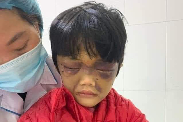 Bà mẹ ở Cẩm Giàng đánh đập con gái 6 tuổi thâm tím mặt Bà mẹ ở Cẩm Giàng đánh đập con gái 6 tuổi thâm tím mặt