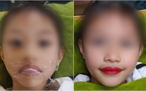 Đại diện thẩm mỹ viện phun môi cho bé gái 5 tuổi lên tiếng: 'Con gái là ngọc ngà trong nhà nên đâu có chuyện làm những gì không tốt cho bé' - 2 Đại diện thẩm mỹ viện phun môi cho bé gái 5 tuổi lên tiếng: 'Con gái là ngọc ngà trong nhà nên đâu có chuyện làm những gì không tốt cho bé' - 2