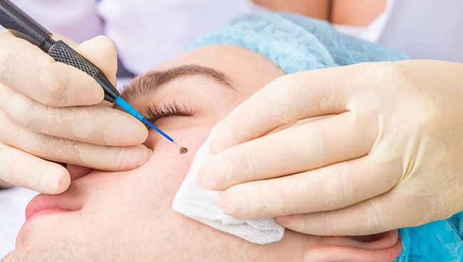 Cô gái 20 tuổi bị vi khuẩn 'ăn' mất nửa van tim chỉ vì đi tẩy nốt ruồi - 2 Cô gái 20 tuổi bị vi khuẩn 'ăn' mất nửa van tim chỉ vì đi tẩy nốt ruồi - 2