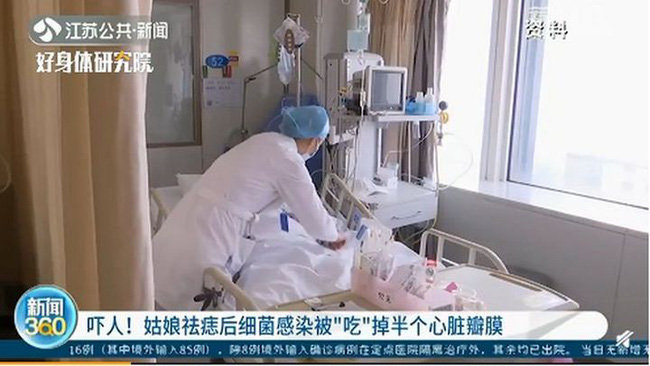 Cô gái 20 tuổi bị vi khuẩn 'ăn' mất nửa van tim chỉ vì đi tẩy nốt ruồi Cô gái 20 tuổi bị vi khuẩn 'ăn' mất nửa van tim chỉ vì đi tẩy nốt ruồi