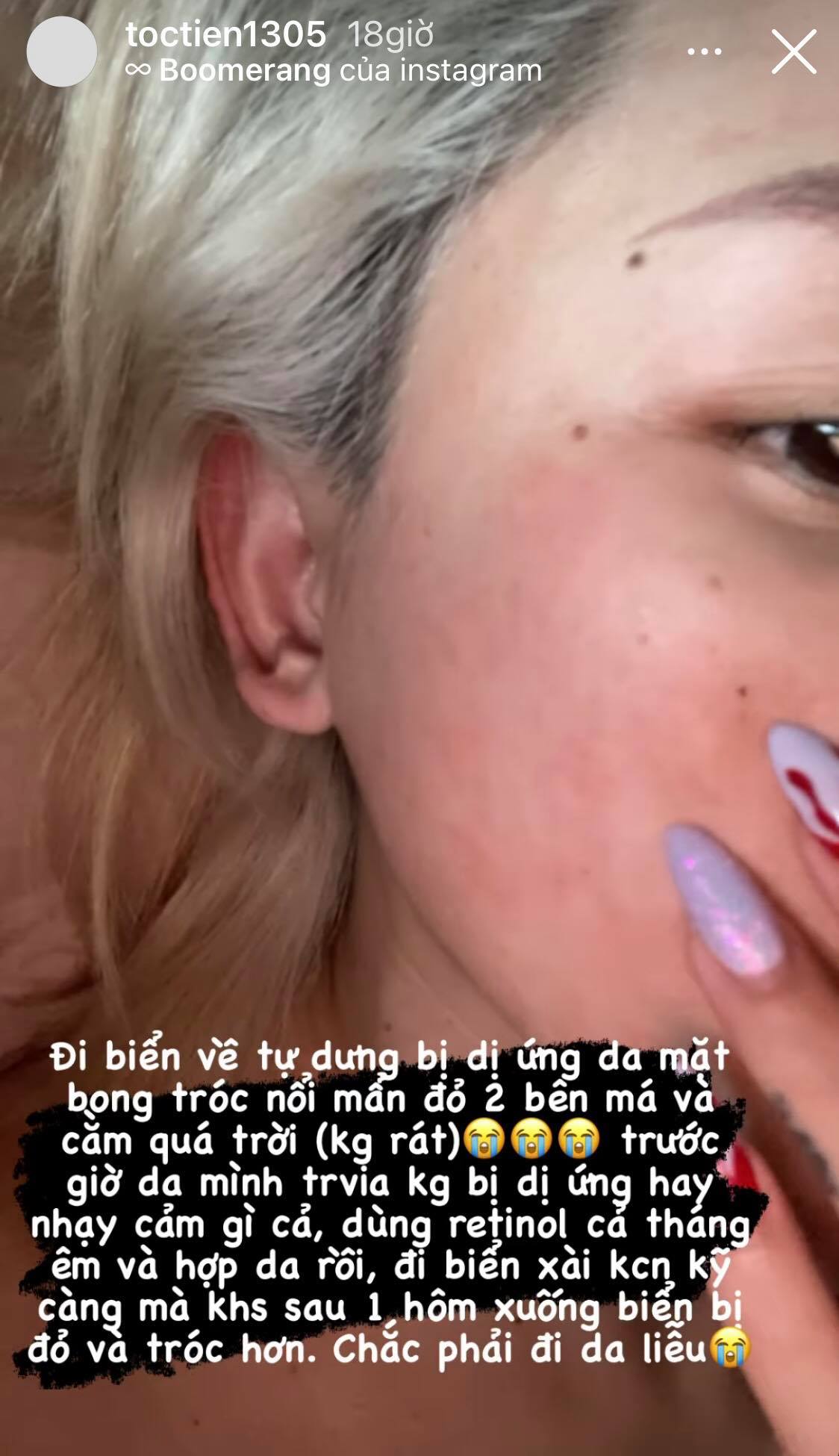 Tóc Tiên chịu cảnh bong tróc mẩn đỏ do dùng retinol, nhờ bôi chất này mà cứu nguy cho cả da mặt - 1 Tóc Tiên chịu cảnh bong tróc mẩn đỏ do dùng retinol, nhờ bôi chất này mà cứu nguy cho cả da mặt - 1