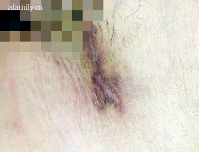 Quan hệ tình dục với nhiều bạn tình, nam thanh niên 28 tuổi nhiễm cùng lúc giang mai và căn bệnh hột xoài hiếm gặp - 2 Quan hệ tình dục với nhiều bạn tình, nam thanh niên 28 tuổi nhiễm cùng lúc giang mai và căn bệnh hột xoài hiếm gặp - 2