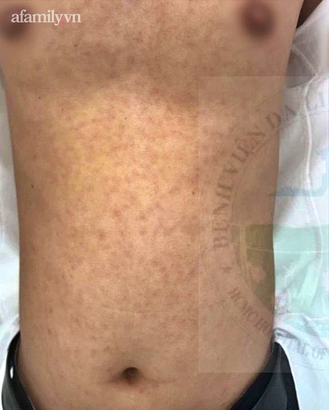 Quan hệ tình dục với nhiều bạn tình, nam thanh niên 28 tuổi nhiễm cùng lúc giang mai và căn bệnh hột xoài hiếm gặp Quan hệ tình dục với nhiều bạn tình, nam thanh niên 28 tuổi nhiễm cùng lúc giang mai và căn bệnh hột xoài hiếm gặp