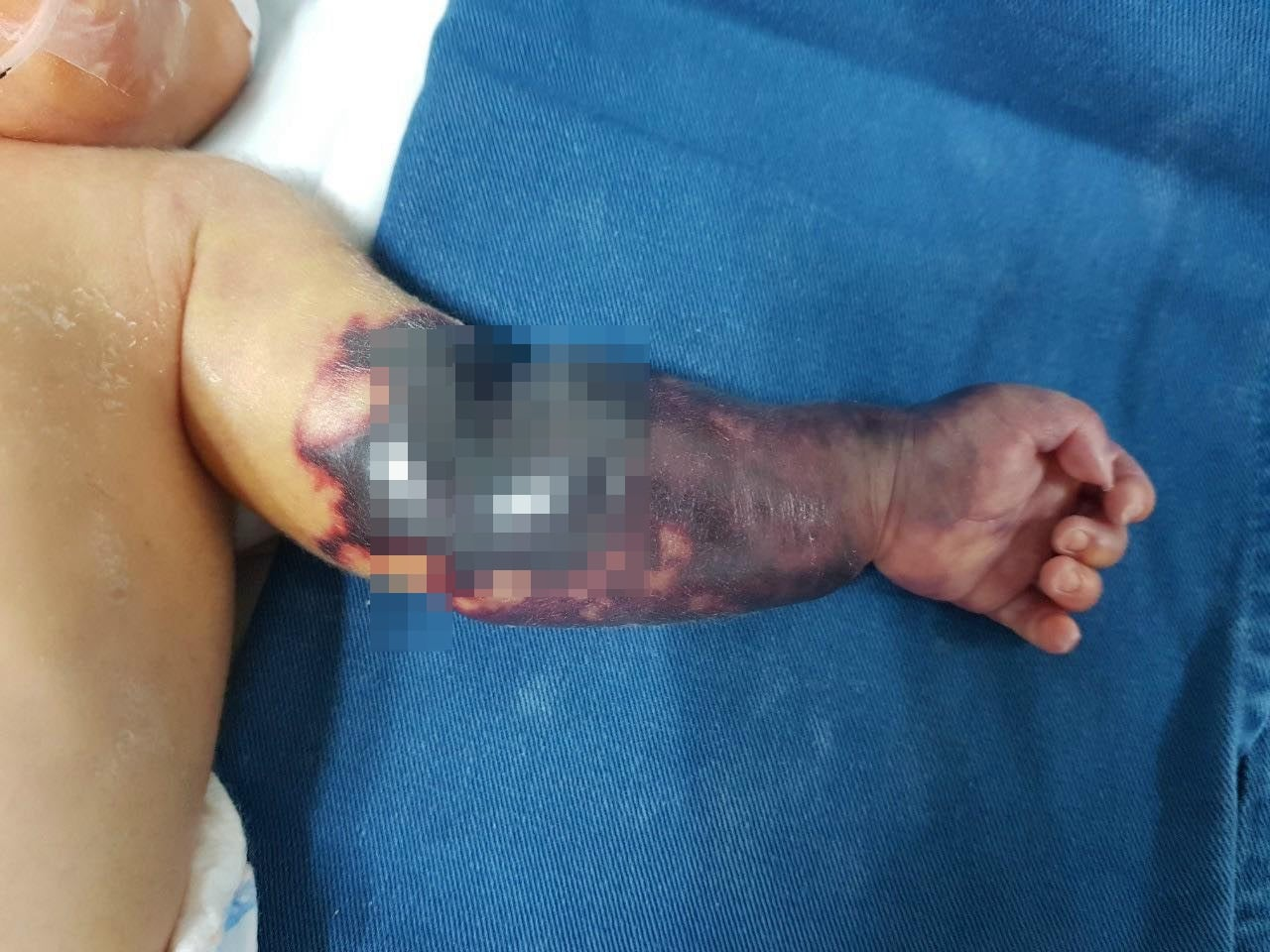 Bé trai sinh non tay sưng phù, đỏ tím vì hội chứng hiếm gặp Bé trai sinh non tay sưng phù, đỏ tím vì hội chứng hiếm gặp