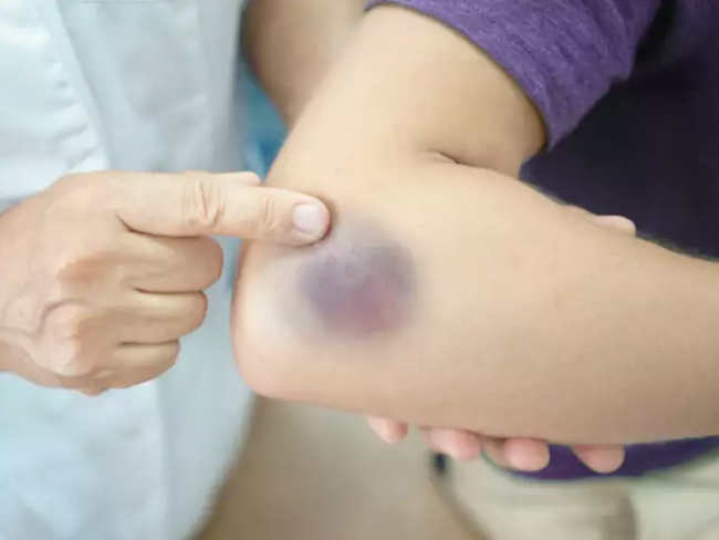 Vết bầm tím trên cơ thể, tưởng đơn giản nhưng có thể là dấu hiệu cảnh báo bệnh lý nguy hiểm - 2 Vết bầm tím trên cơ thể, tưởng đơn giản nhưng có thể là dấu hiệu cảnh báo bệnh lý nguy hiểm - 2
