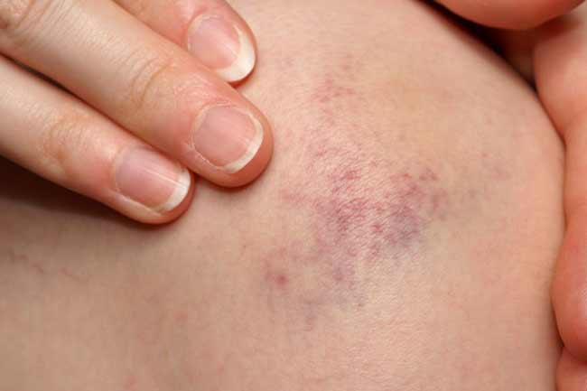 Vết bầm tím trên cơ thể, tưởng đơn giản nhưng có thể là dấu hiệu cảnh báo bệnh lý nguy hiểm Vết bầm tím trên cơ thể, tưởng đơn giản nhưng có thể là dấu hiệu cảnh báo bệnh lý nguy hiểm