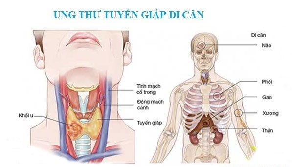 Ung thư tuyến giáp di căn sau 16 năm được cứu sống ngoạn mục - 2 Ung thư tuyến giáp di căn sau 16 năm được cứu sống ngoạn mục - 2
