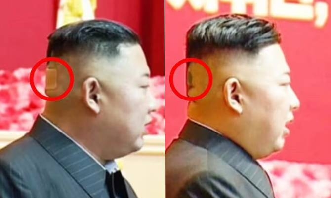 Miếng băng y tế lớn sau đầu Kim Jong-un gây chú ý Miếng băng y tế lớn sau đầu Kim Jong-un gây chú ý