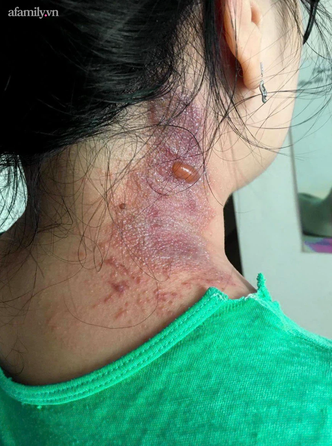 Viêm da vì kiến ba khoang, nhiều bệnh nhân gánh hậu quả mùa dịch Viêm da vì kiến ba khoang, nhiều bệnh nhân gánh hậu quả mùa dịch