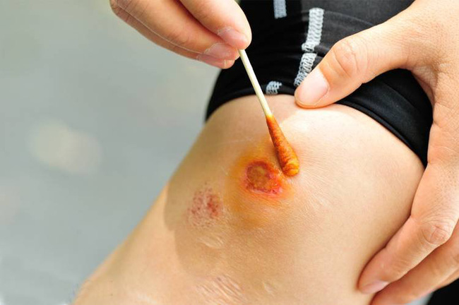 Xuất hiện trào lưu dùng Betadine làm thuốc xịt mũi, nước súc miệng để ngăn chặn Covid-19: Chuyên gia lên tiếng cảnh báo! - 1 Xuất hiện trào lưu dùng Betadine làm thuốc xịt mũi, nước súc miệng để ngăn chặn Covid-19: Chuyên gia lên tiếng cảnh báo! - 1