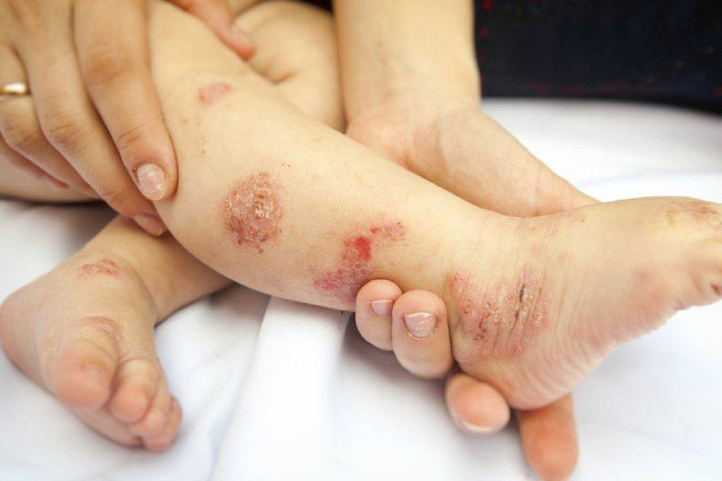 Viêm da cơ địa 'hành hạ' trẻ nhỏ vào mùa thu đông: Chuyên gia chỉ ra bài thuốc trị dứt điểm, nguyên liệu có sẵn trong bếp, vừa rẻ lại hiệu quả - 1 Viêm da cơ địa 'hành hạ' trẻ nhỏ vào mùa thu đông: Chuyên gia chỉ ra bài thuốc trị dứt điểm, nguyên liệu có sẵn trong bếp, vừa rẻ lại hiệu quả - 1