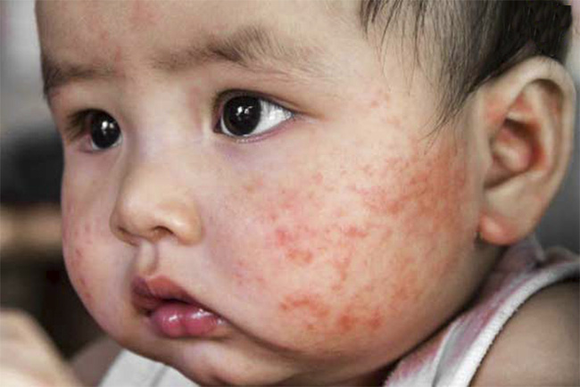 Viêm da cơ địa 'hành hạ' trẻ nhỏ vào mùa thu đông: Chuyên gia chỉ ra bài thuốc trị dứt điểm, nguyên liệu có sẵn trong bếp, vừa rẻ lại hiệu quả Viêm da cơ địa 'hành hạ' trẻ nhỏ vào mùa thu đông: Chuyên gia chỉ ra bài thuốc trị dứt điểm, nguyên liệu có sẵn trong bếp, vừa rẻ lại hiệu quả