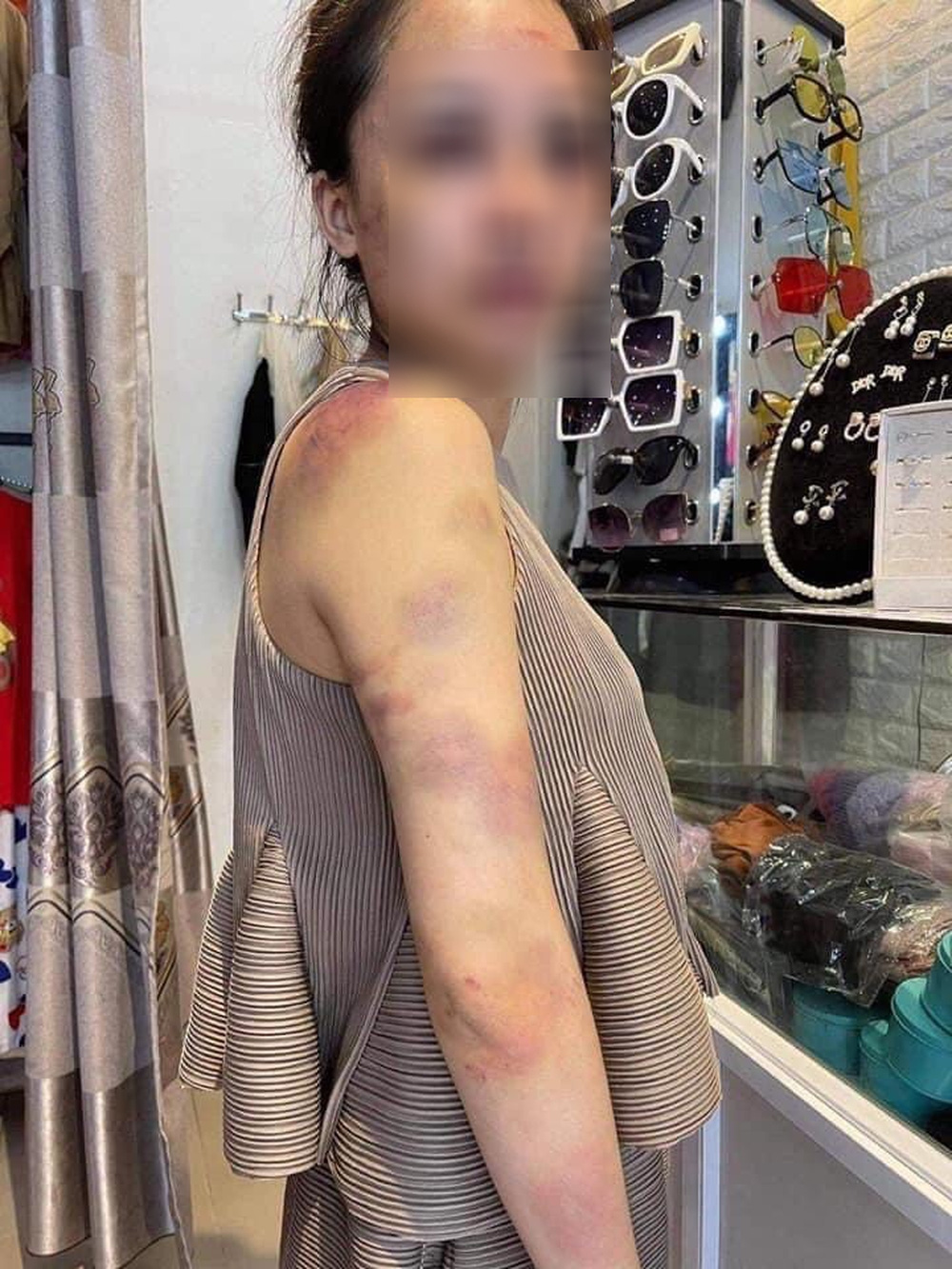 Cô gái tố bị chồng đánh từ 23h đến 4h sáng hôm sau, bằng cả gậy sắt, người chồng đã 'lộ diện' Cô gái tố bị chồng đánh từ 23h đến 4h sáng hôm sau, bằng cả gậy sắt, người chồng đã 'lộ diện'