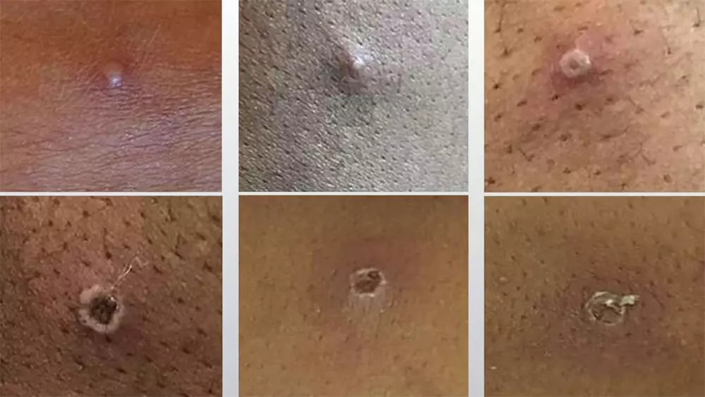 Nguồn gốc lây lan khó hiểu của bệnh đậu mùa khỉ Nguồn gốc lây lan khó hiểu của bệnh đậu mùa khỉ