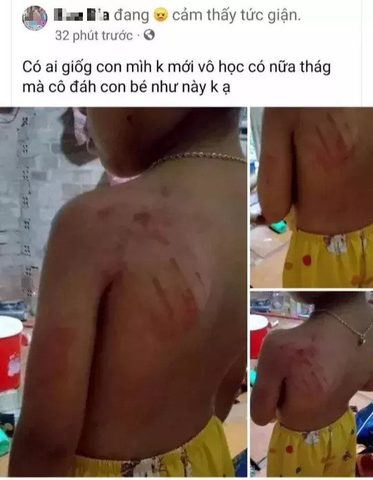 Học sinh lớp 1 bị cô giáo đánh bầm tím vai vì viết chậm Học sinh lớp 1 bị cô giáo đánh bầm tím vai vì viết chậm