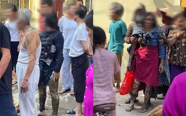 Vụ 3 con gái mang xăng đốt nhà mẹ ở Hưng Yên: Người mẹ bắt đầu được ghép da - 1 Vụ 3 con gái mang xăng đốt nhà mẹ ở Hưng Yên: Người mẹ bắt đầu được ghép da - 1