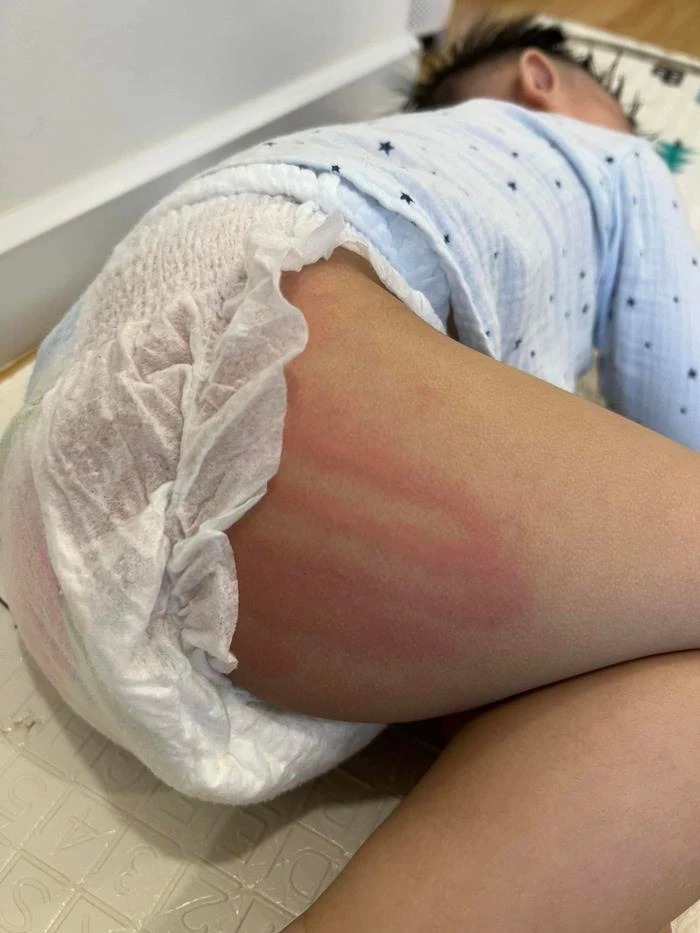 Nữ ca sĩ đăng kèm hình ảnh vùng mông của bé bị ửng đỏ nghi vấn đã bị tác động vật lý.