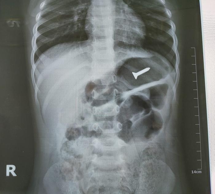 Kết quả chụp X-Quang cho thấy có 1 di vật cản quang trong ống tiêu hóa cao. (Ảnh: BVCC).