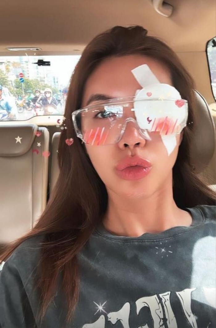 Minh Tú gặp sự cố ở mắt và tự nhận đây chính là 