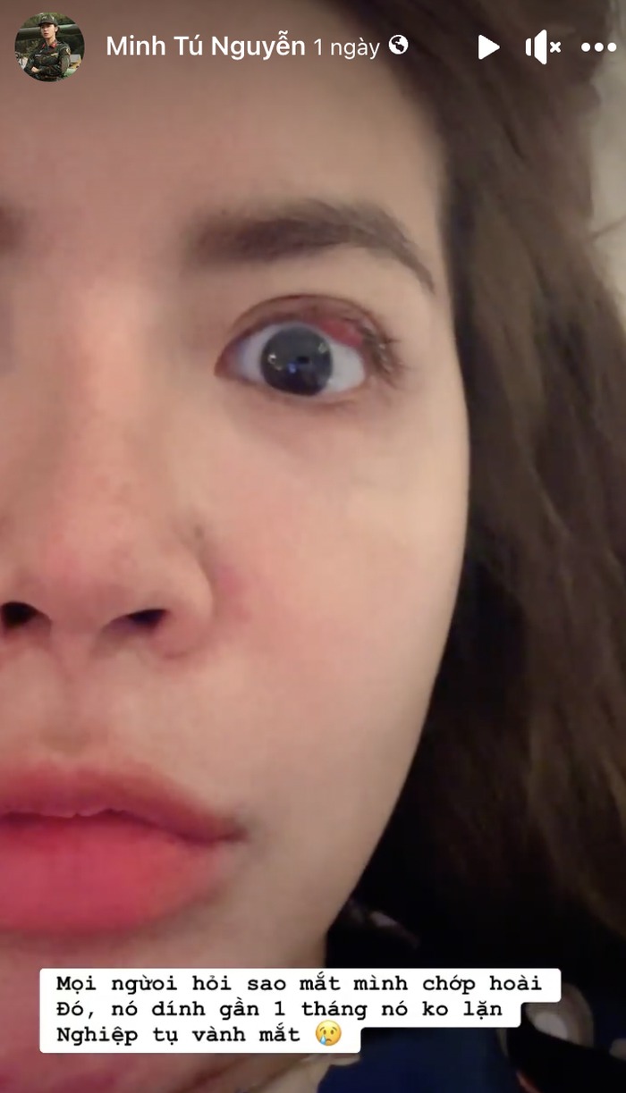 Minh Tú đã bị sưng đỏ vùng mí mắt trái trong suốt 1 tháng ròng. (Ảnh chụp màn hình)