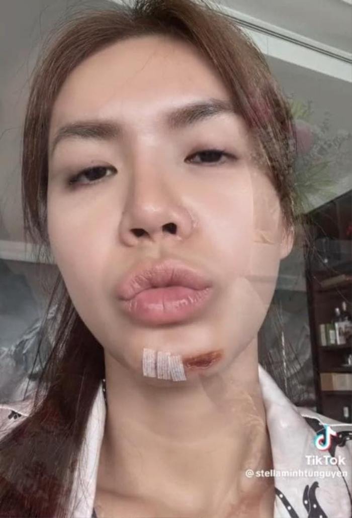 Trước đó, Minh Tú cũng gặp tai nạn ở phần cằm, phải may 10 mũi liền. (Ảnh tổng hợp)