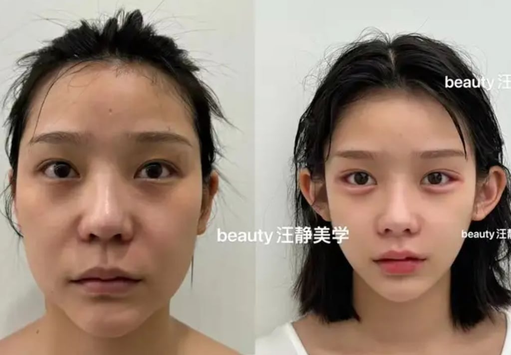 Khuôn mặt baby của cô Wang được ngành phẫu thuật thẩm mỹ ca ngợi là hình mẫu hoàn hảo cho loại khuôn mặt này.