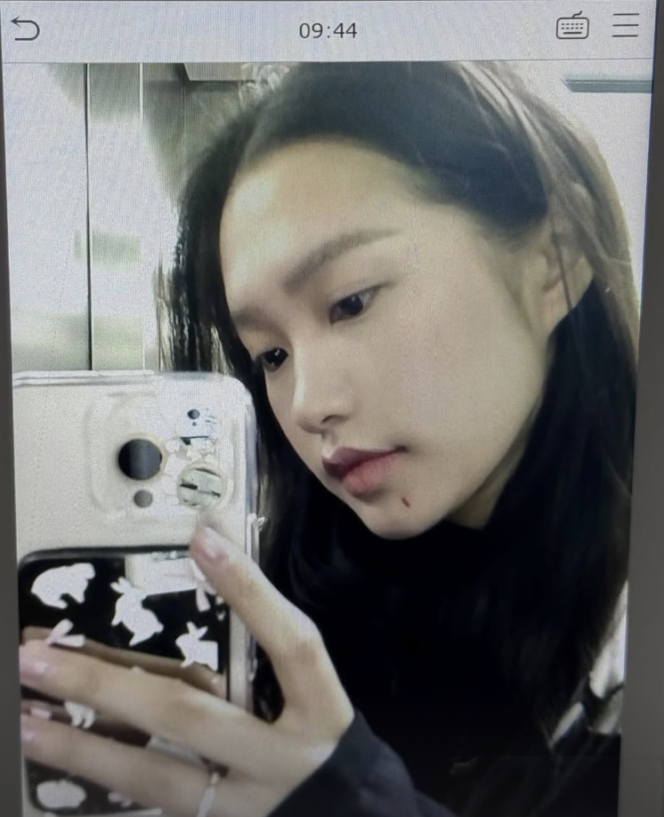 Doãn Hải My than bị vết xước trên mặt