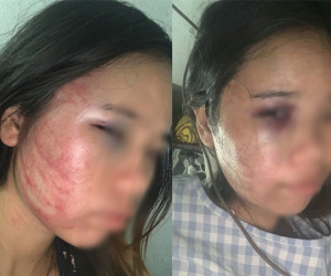 Xót xa người vợ mang bầu 7 tháng vẫn bị chồng đánh bầm dập, đau lòng hơn khi bố ruột vừa mới qua đời